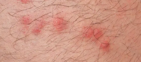 τσίμπημα ψύλλου κόκκινα σπυράκια στο δέρμα με φαγούρα