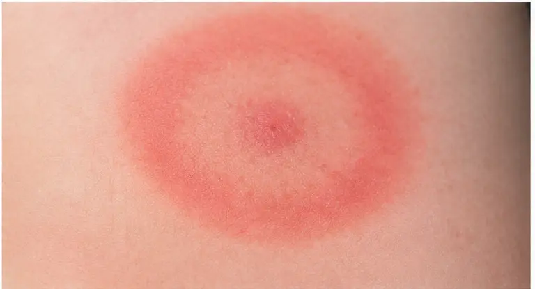 εξάνθημα Lyme μετά από τσίμπημα τσιμπουριού – κυκλικό ερυθρό σημάδι